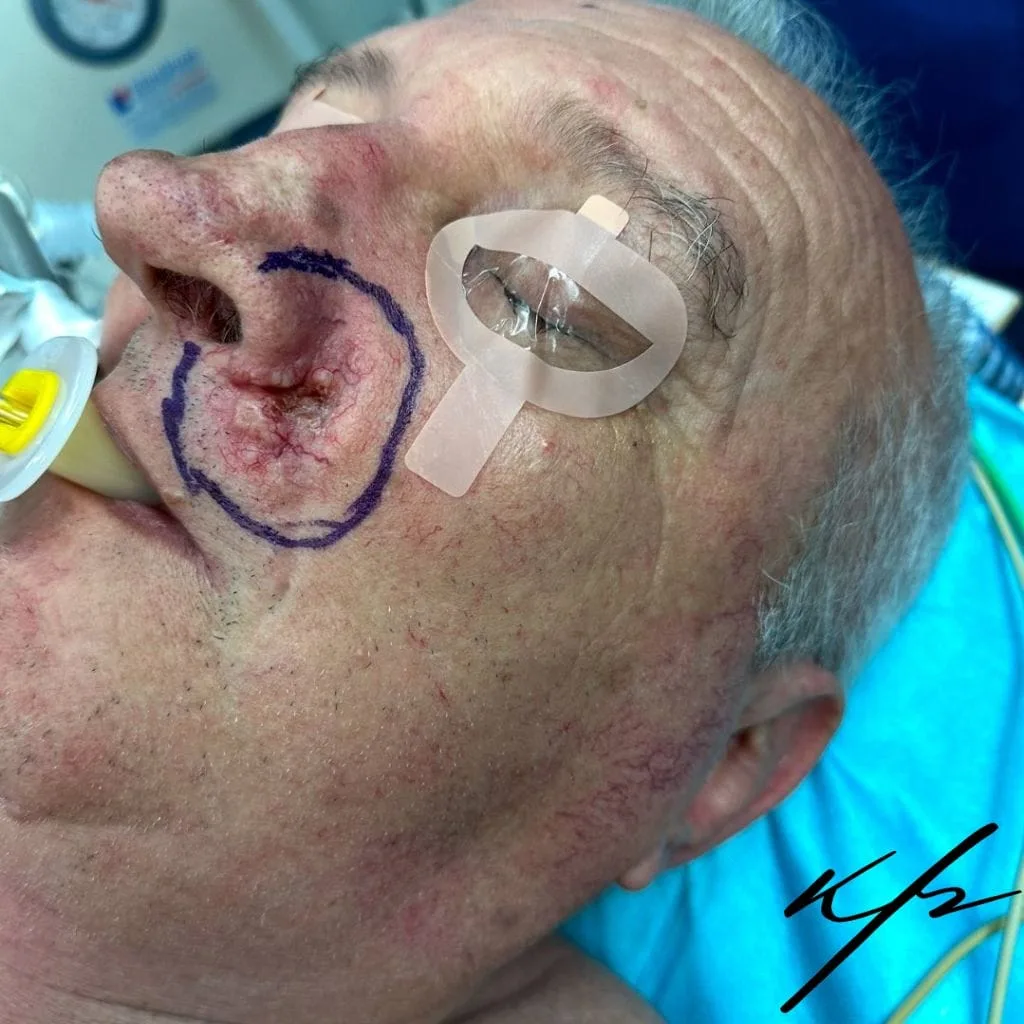 Βασικοκυτταρικό καρκίνωμα παρειάς και αποκατάσταση