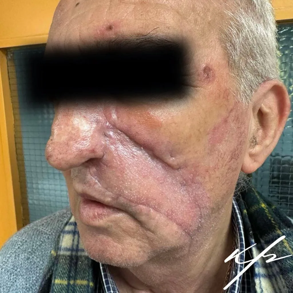 Βασικοκυτταρικό καρκίνωμα παρειάς και αποκατάσταση