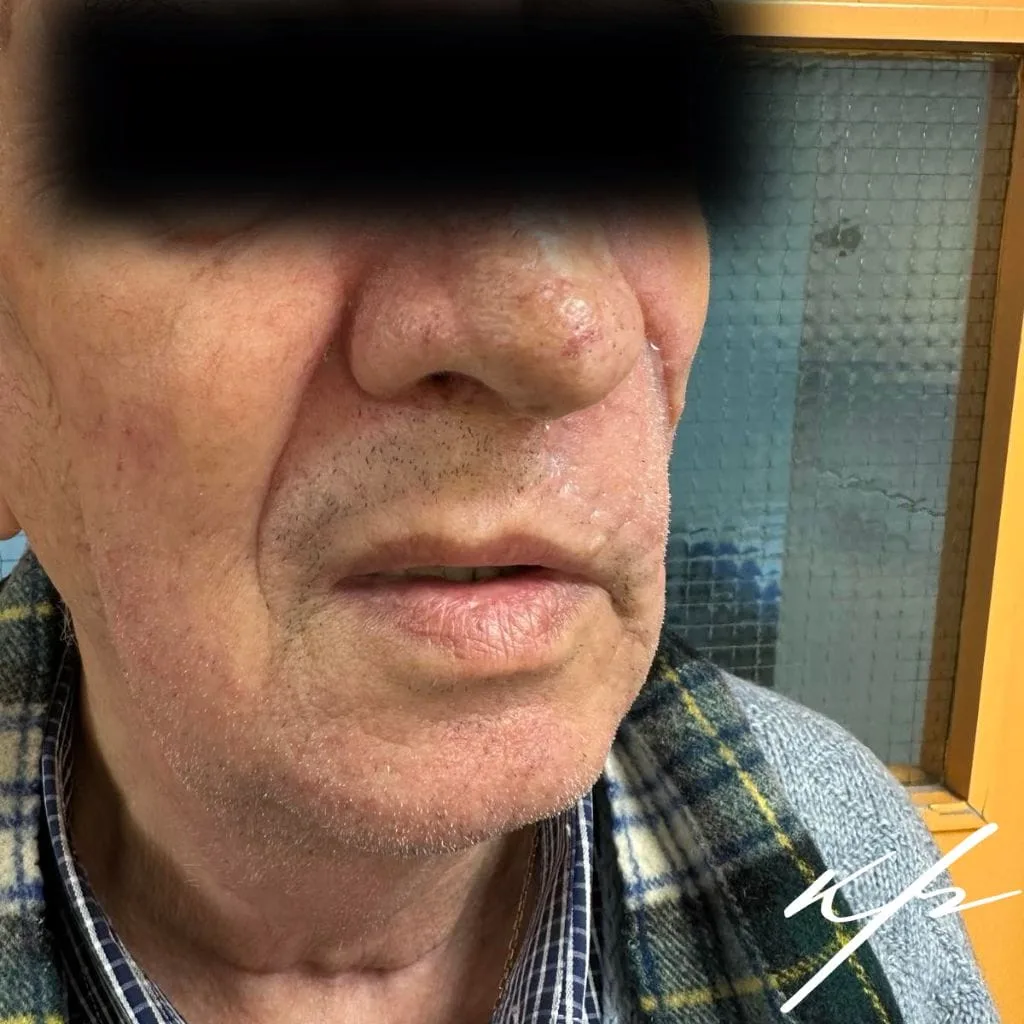 Βασικοκυτταρικό καρκίνωμα παρειάς και αποκατάσταση