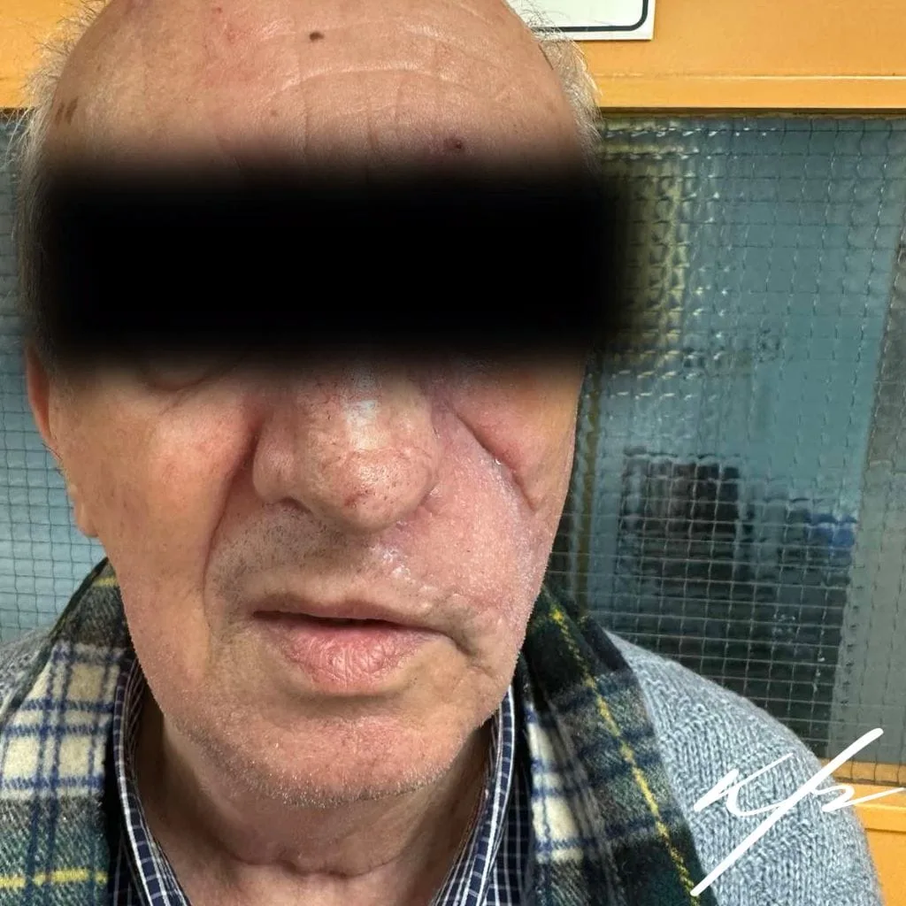 Βασικοκυτταρικό καρκίνωμα παρειάς και αποκατάσταση