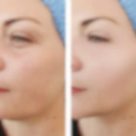 Ενέσιμη θεραπεία και βλεφαροπλαστική - ικανοποιημένη ασθενής